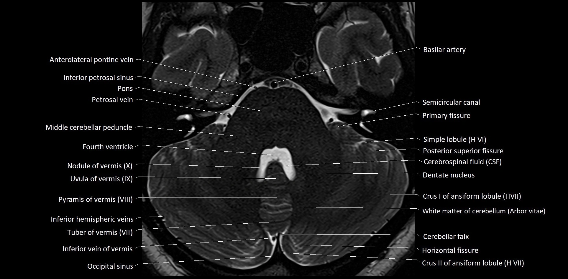 MRI Cerebellar anatomy High-resolution labelled 3T MRI image 14.webp